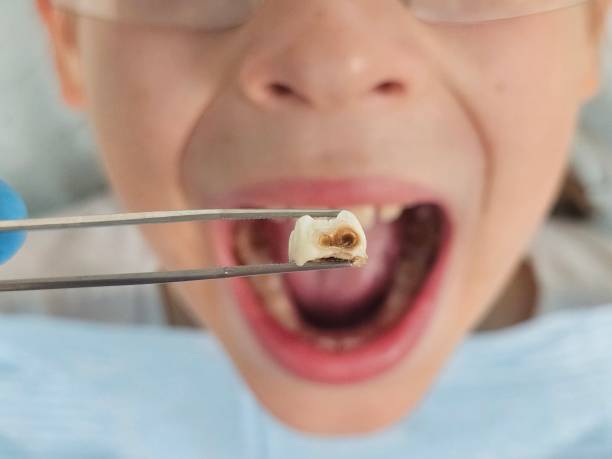 Best Emergency Dentist for Lost Fillings or Crowns in Keizer, OR